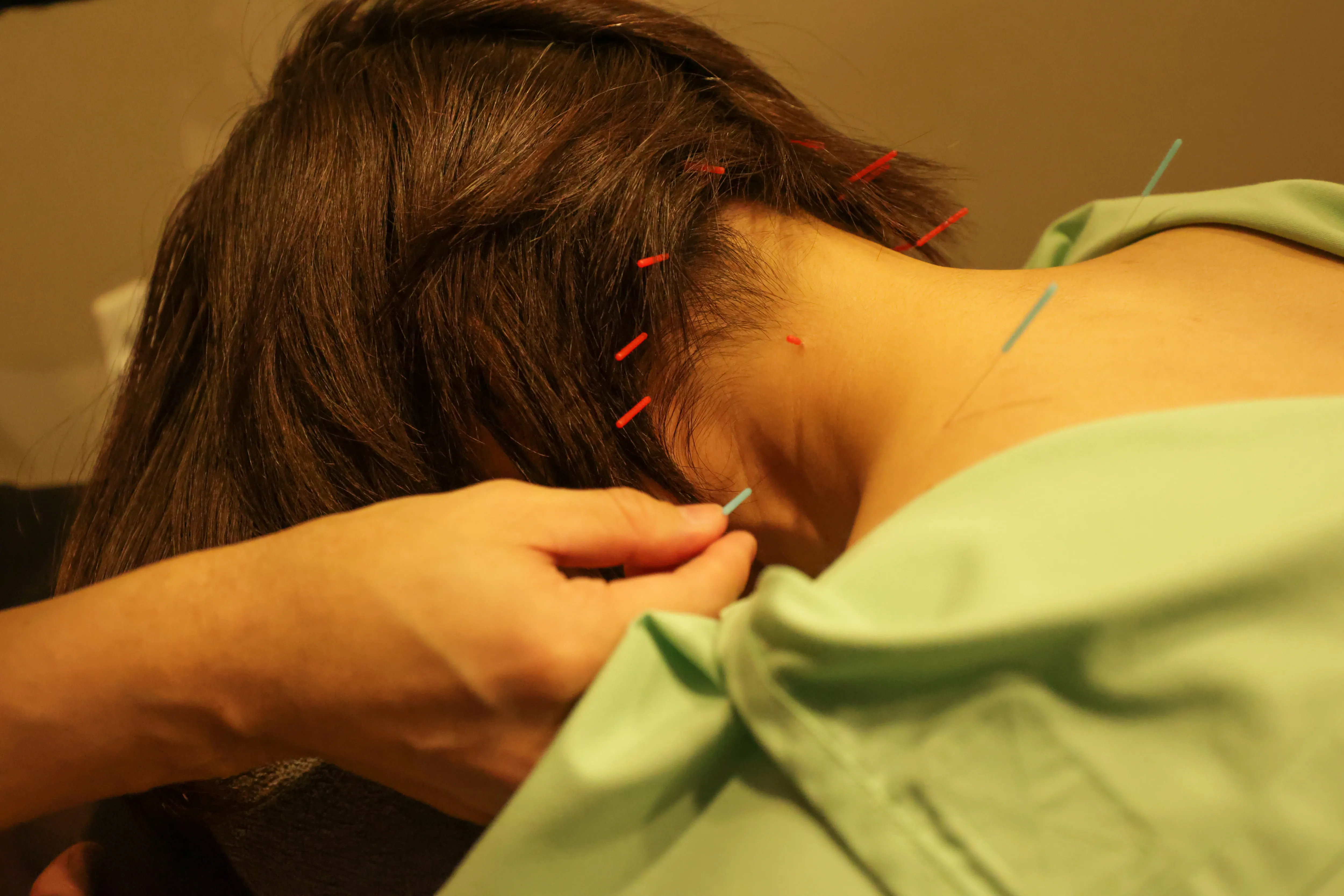 鍼治療を受けている女性の写真